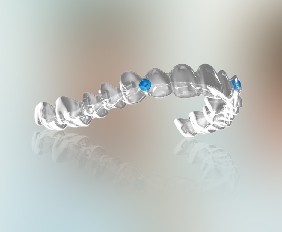 Why Choose Angel Aligner at Auckland City Orthodontics? Why Choose Angel Aligner at Auckland City Orthodontics?