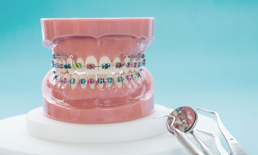 Braces costs in NZ: what affects price and how to budget