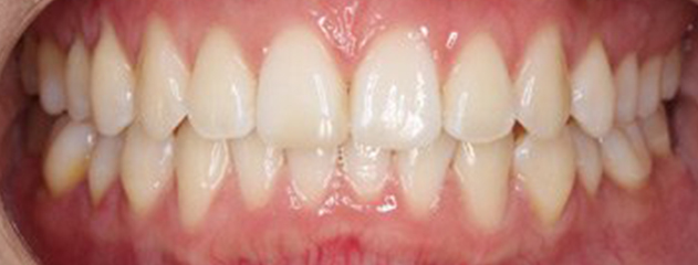 After Invisalign® treatment at Auckland City Orthodontics
