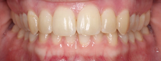 After Fixed braces treatment at Auckland City Orthodontics