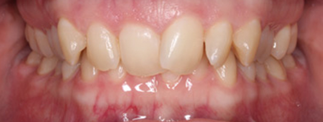Before Fixed braces treatment