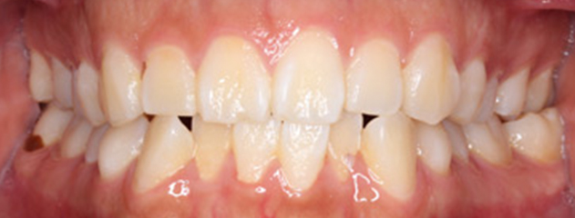Before Invisalign® treatment