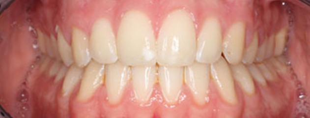 After Ceramic braces treatment at Auckland City Orthodontics