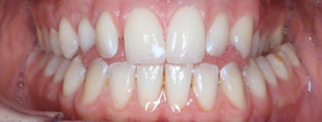 Before Ceramic braces treatment