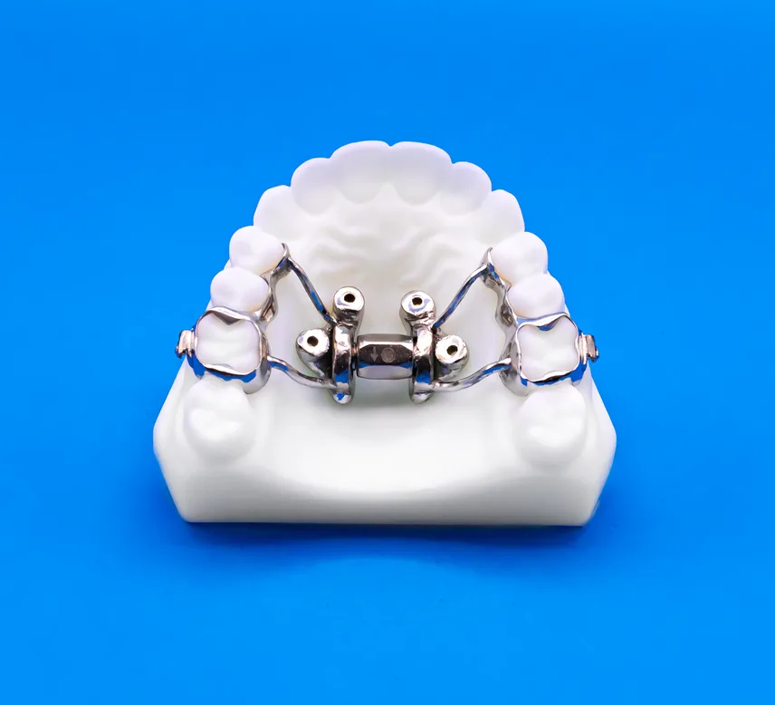 MARPE appliance on a model of the upper jaw, with a central expansion screw and four miniscrew anchor points