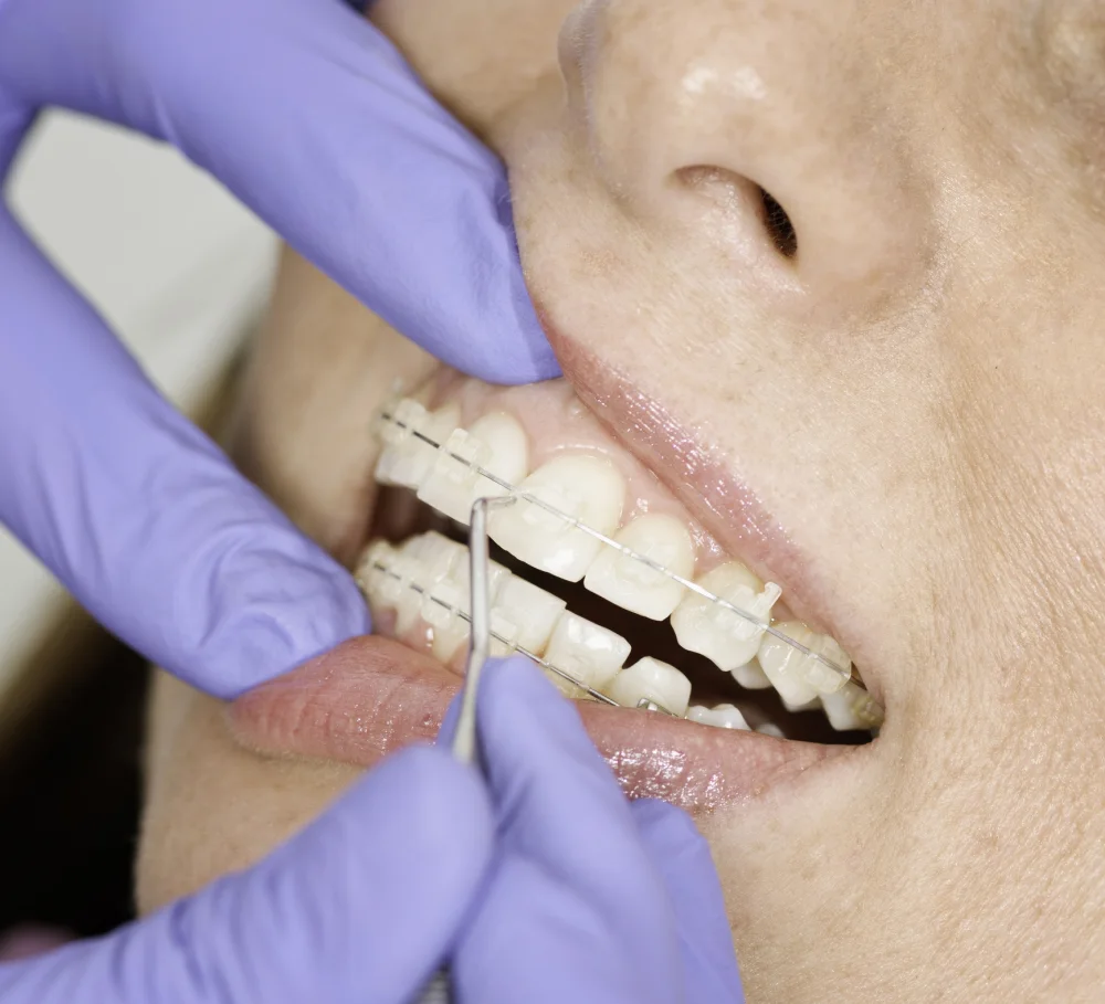 Close-up of ceramic braces being fitted